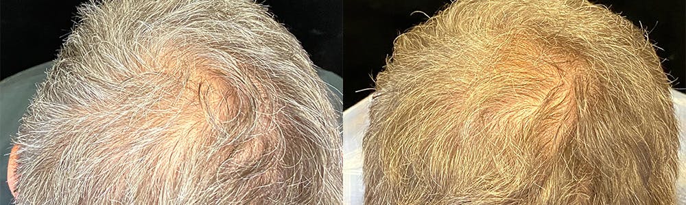 PRP Hair Restoration Before & After Gallery - Patient 145329 - Image 2