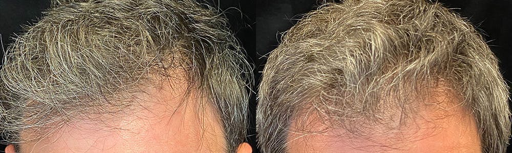 PRP Hair Restoration Before & After Gallery - Patient 145329 - Image 3