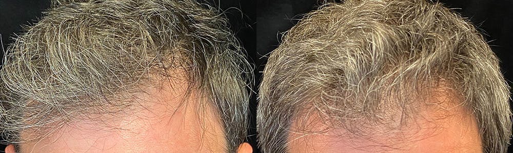 PRP Hair Restoration Before & After Gallery - Patient 145329 - Image 3