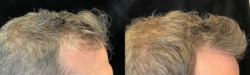 PRP Hair Restoration Before & After Gallery - Patient 145329 - Image 4
