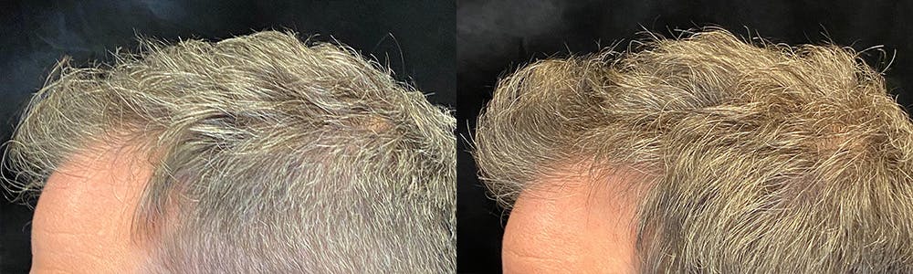 PRP Hair Restoration Before & After Gallery - Patient 145329 - Image 5