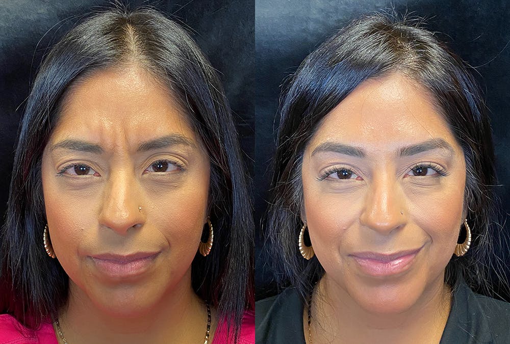 BOTOX/Dysport Before & After Gallery - Patient 230724 - Image 1