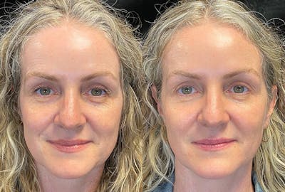 Dermal Fillers Before & After Gallery - Patient 289095 - Image 1