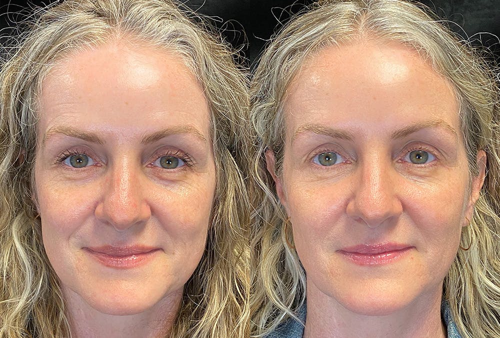 Dermal Fillers Before & After Gallery - Patient 289095 - Image 1