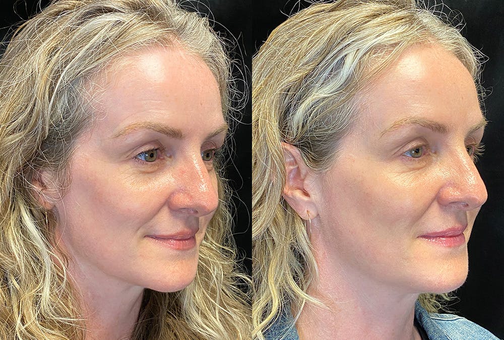 Dermal Fillers Before & After Gallery - Patient 289095 - Image 2