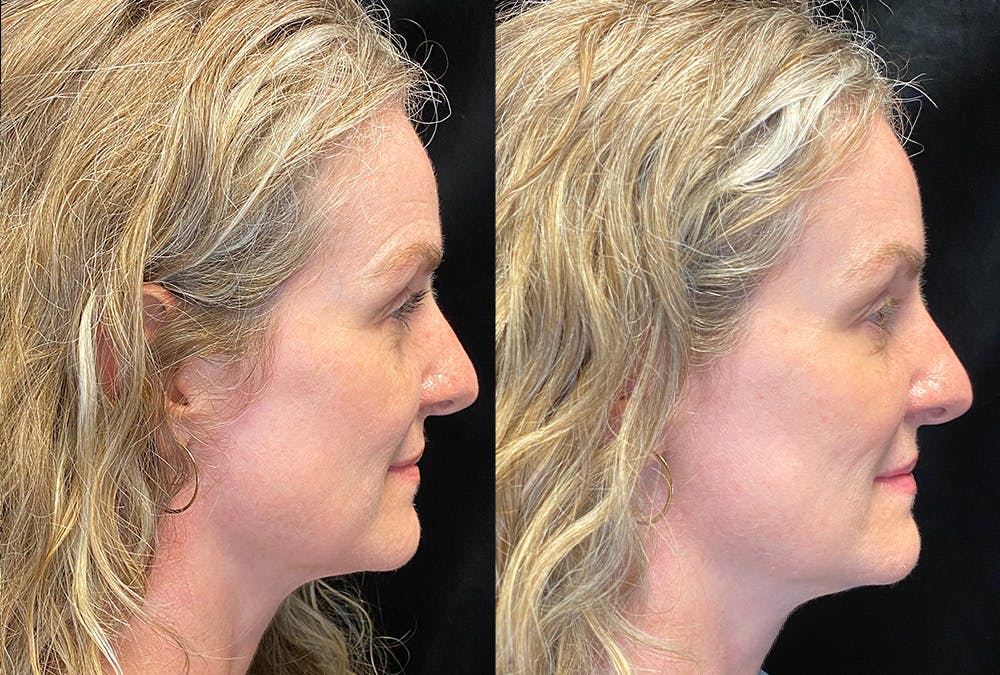 Dermal Fillers Before & After Gallery - Patient 289095 - Image 3