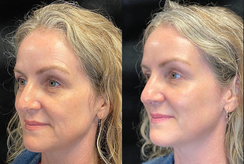 Dermal Fillers Before & After Gallery - Patient 289095 - Image 4
