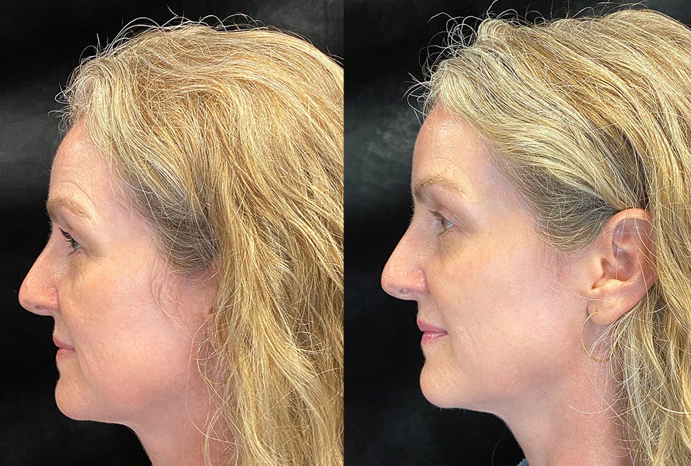 Dermal Fillers Before & After Gallery - Patient 289095 - Image 5