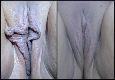 Labiaplasty Before & After Gallery - Patient 110808 - Image 1