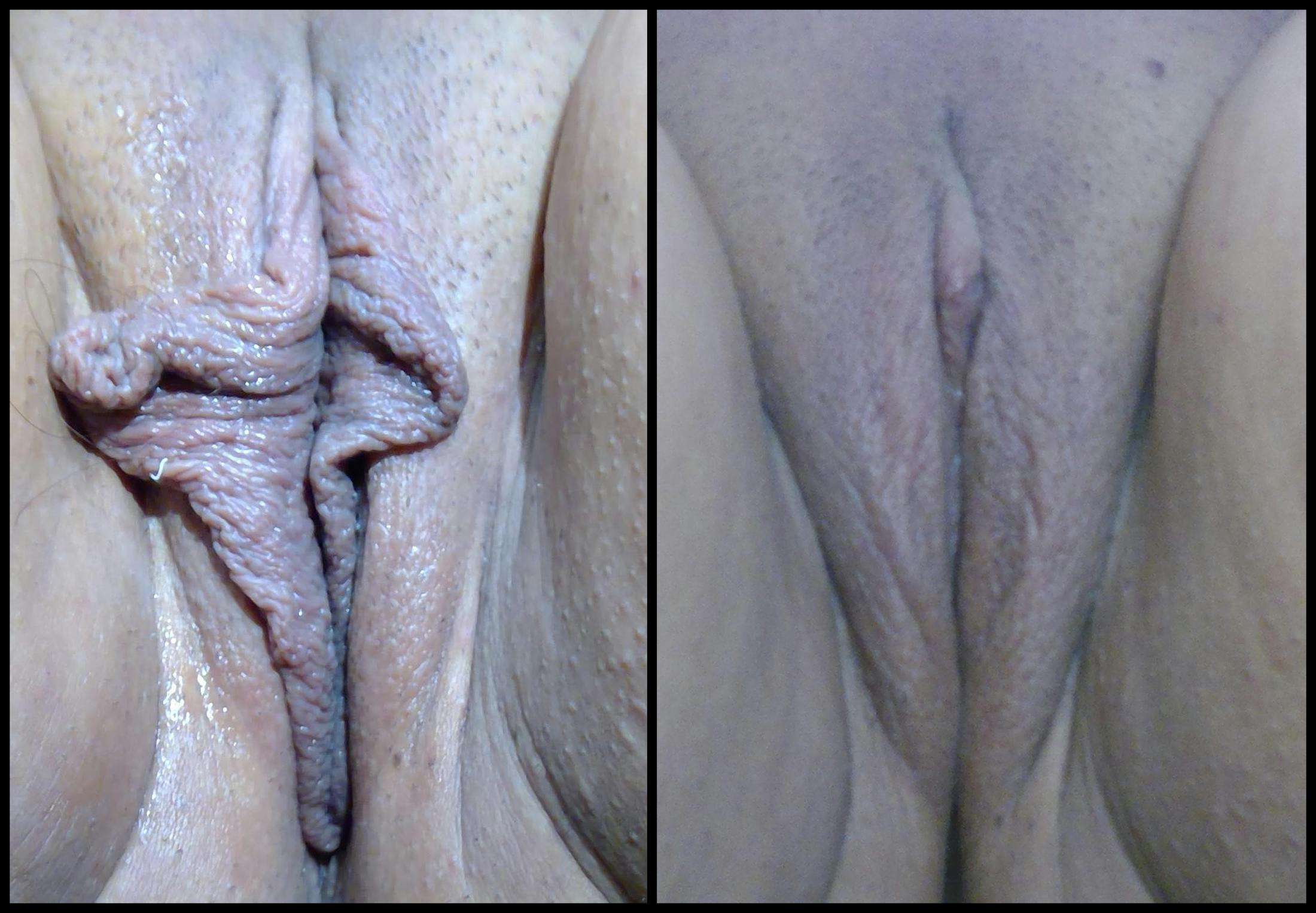 Labiaplasty Before & After Gallery - Patient 110808 - Image 1