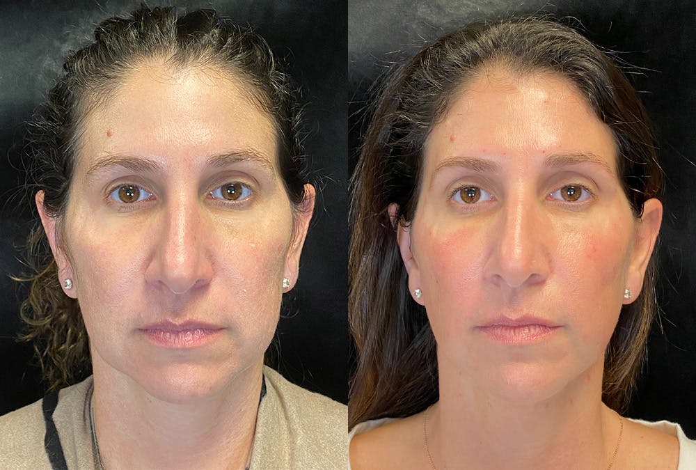 Sculptra Before & After Gallery - Patient 219260 - Image 1