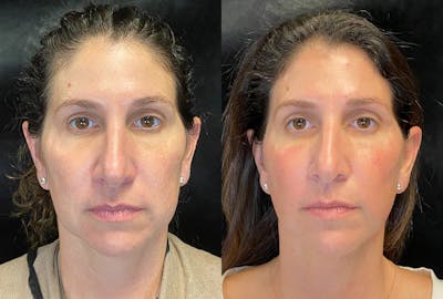 Dermal Fillers Before & After Gallery - Patient 838802 - Image 1
