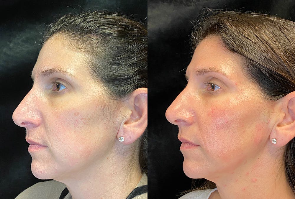 Sculptra Before & After Gallery - Patient 219260 - Image 2