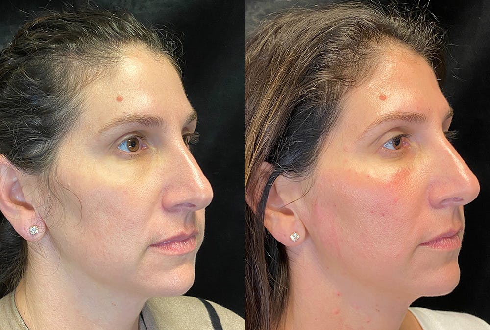 Sculptra Before & After Gallery - Patient 219260 - Image 3