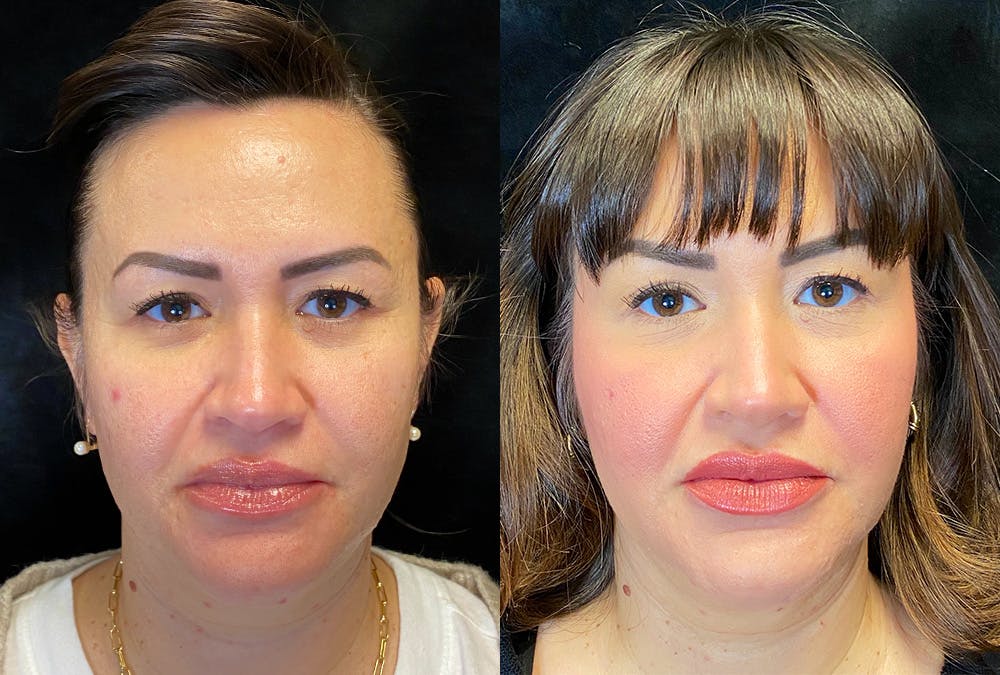 BOTOX/Dysport Before & After Gallery - Patient 349148 - Image 1