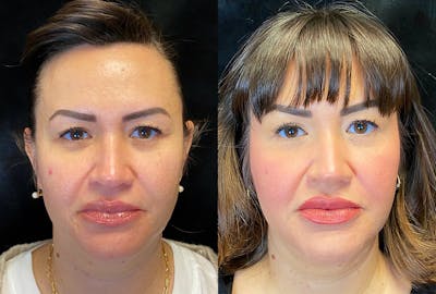 Dermal Fillers Before & After Gallery - Patient 369752 - Image 1