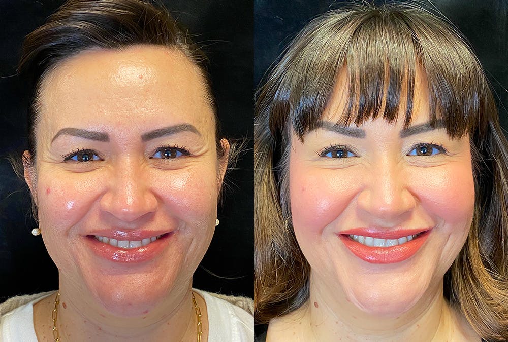 BOTOX/Dysport Before & After Gallery - Patient 349148 - Image 2