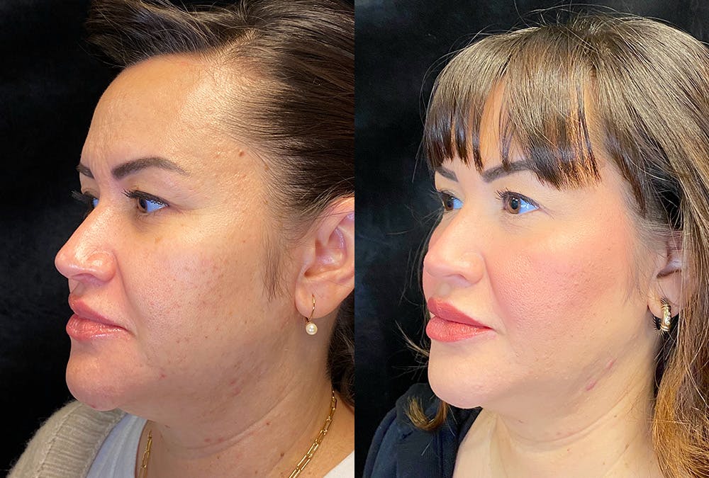 BOTOX/Dysport Before & After Gallery - Patient 349148 - Image 3