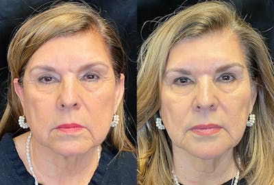 Dermal Fillers Before & After Gallery - Patient 296040 - Image 1