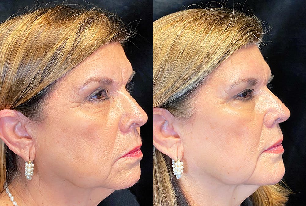 Dermal Fillers Before & After Gallery - Patient 296040 - Image 2