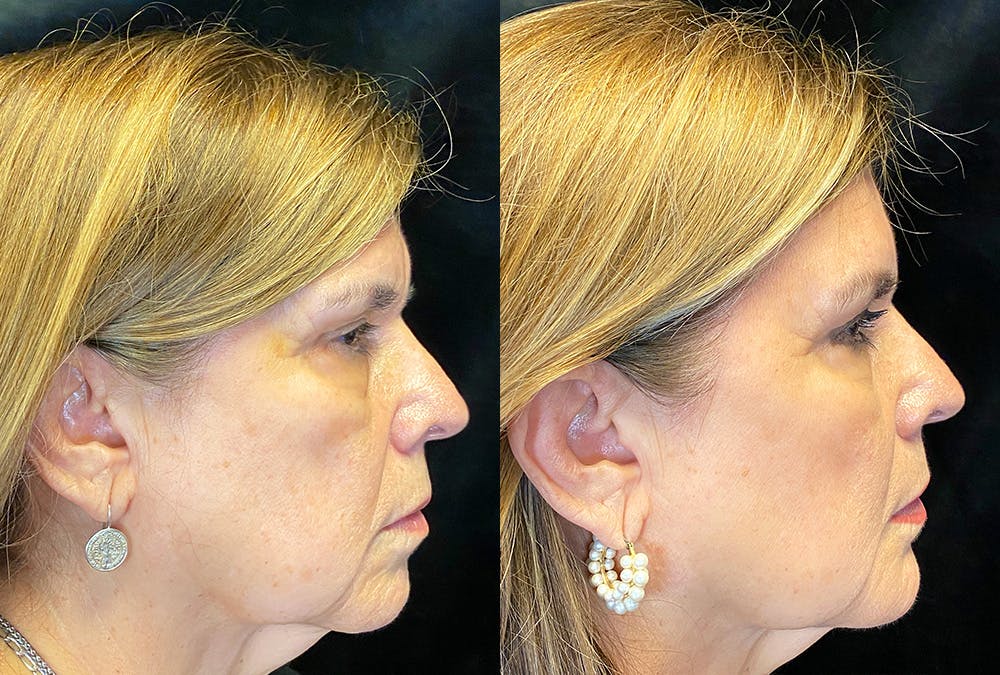 BOTOX/Dysport Before & After Gallery - Patient 182750 - Image 3