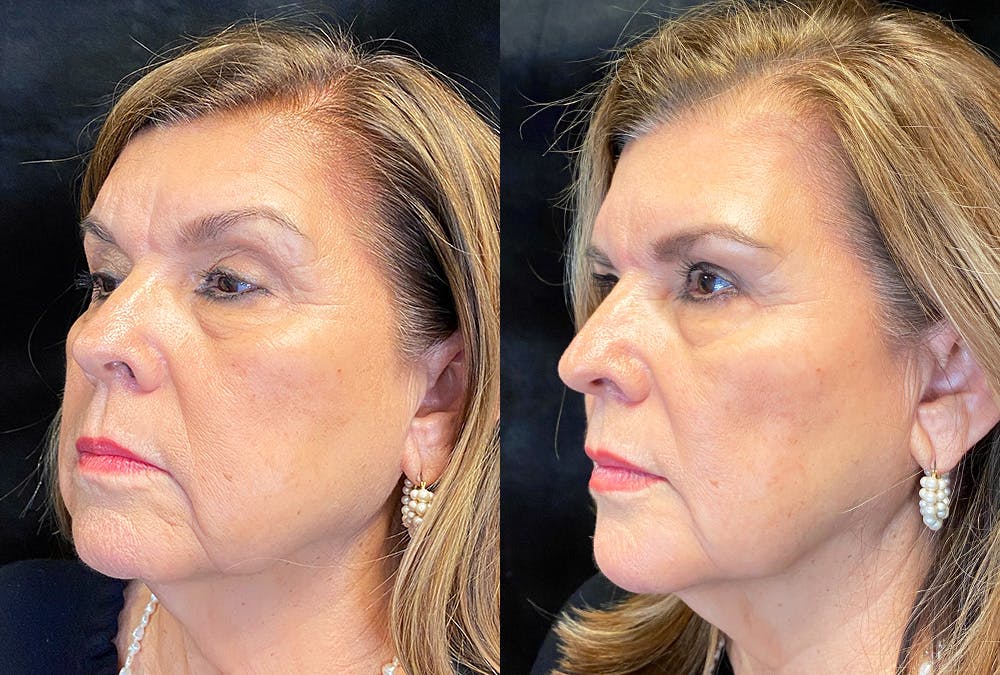 BOTOX/Dysport Before & After Gallery - Patient 182750 - Image 4