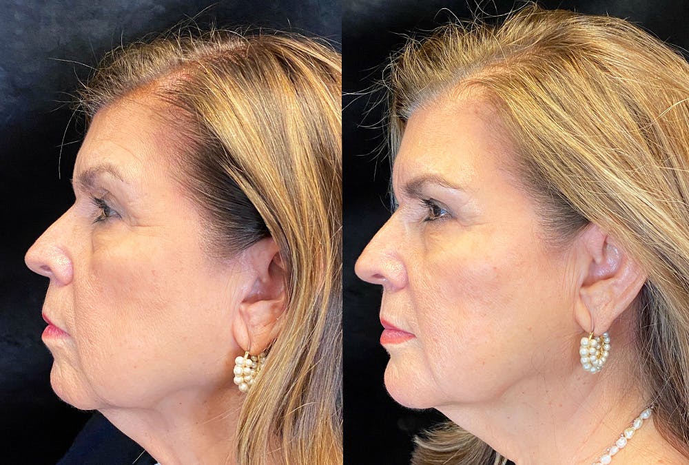 Dermal Fillers Before & After Gallery - Patient 296040 - Image 5