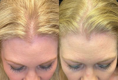 PRP Hair Restoration Before & After Gallery - Patient 365788 - Image 1