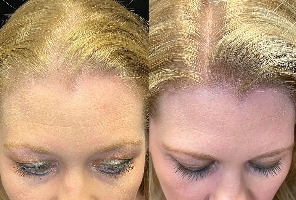 PRP Hair Restoration Before & After Gallery - Patient 365788 - Image 2