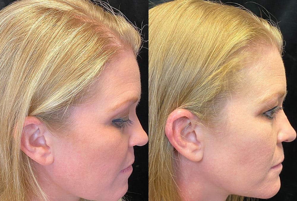PRP Hair Restoration Before & After Gallery - Patient 365788 - Image 3
