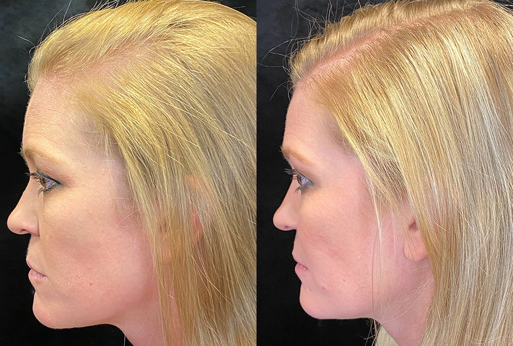 PRP Hair Restoration Before & After Gallery - Patient 365788 - Image 4