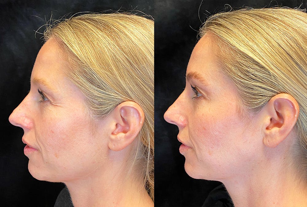 BOTOX/Dysport Before & After Gallery - Patient 219685 - Image 2
