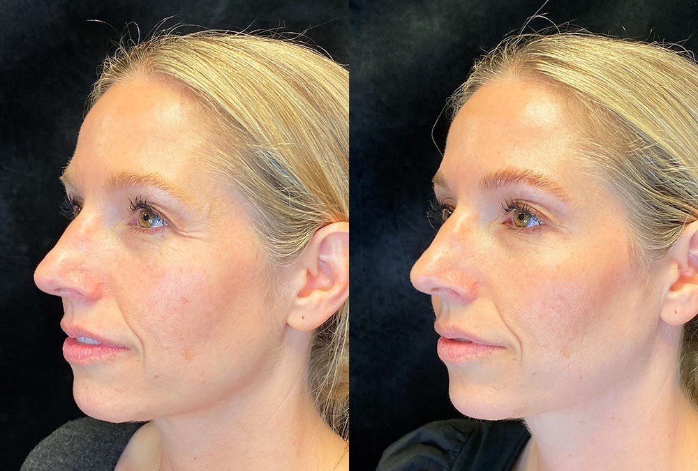 Dermal Fillers Before & After Gallery - Patient 294922 - Image 1