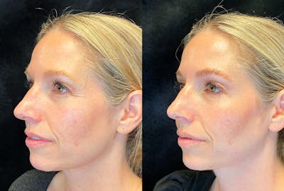 Dermal Fillers Before & After Gallery - Patient 294922 - Image 1