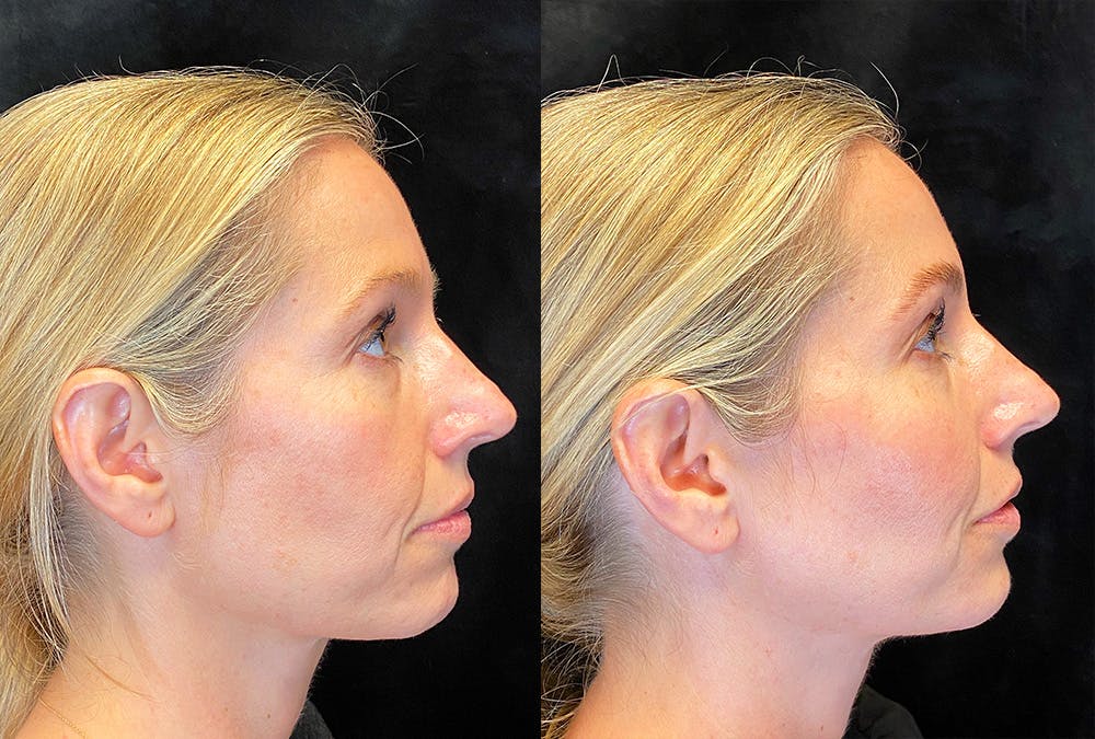 Dermal Fillers Before & After Gallery - Patient 294922 - Image 3