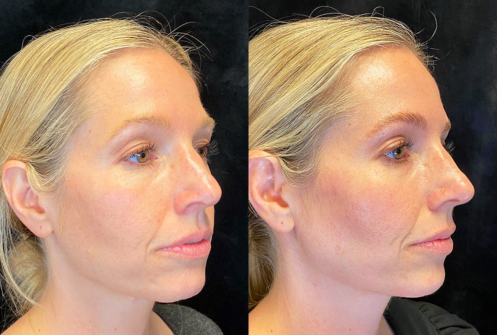 BOTOX/Dysport Before & After Gallery - Patient 219685 - Image 4