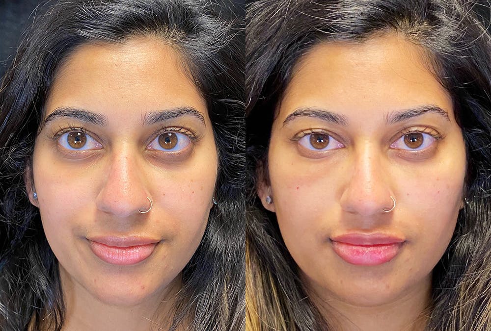 Dermal Fillers Before & After Gallery - Patient 222927 - Image 1