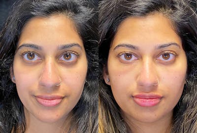 Dermal Fillers Before & After Gallery - Patient 222927 - Image 1