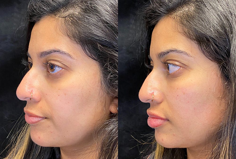 Dermal Fillers Before & After Gallery - Patient 222927 - Image 2
