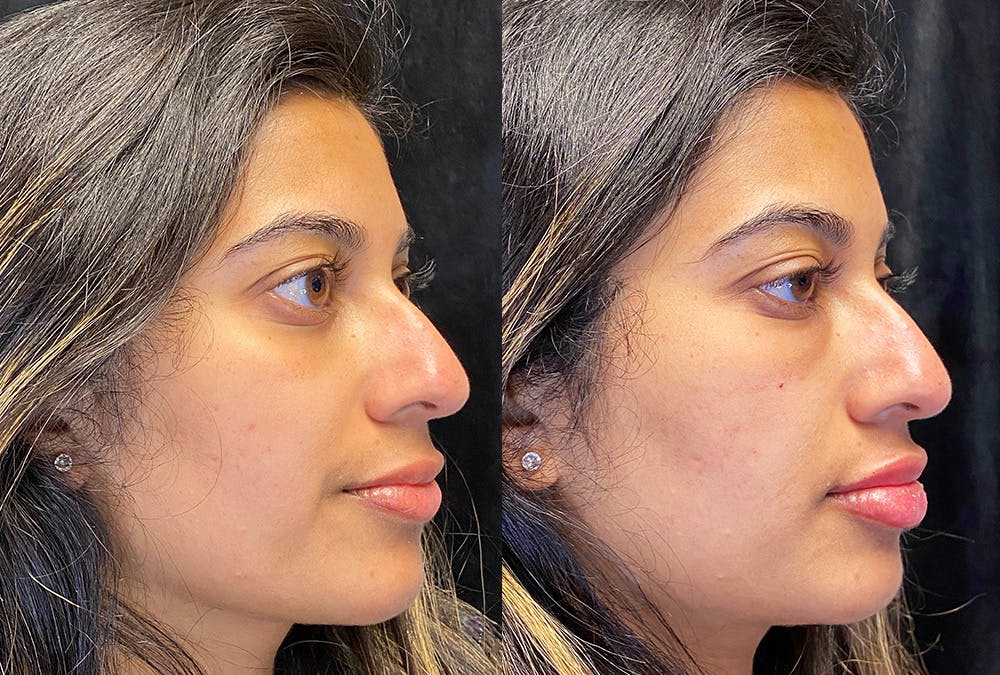 Dermal Fillers Before & After Gallery - Patient 222927 - Image 3