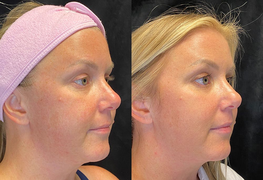 Morpheus8 Before & After Gallery - Patient 107575 - Image 5