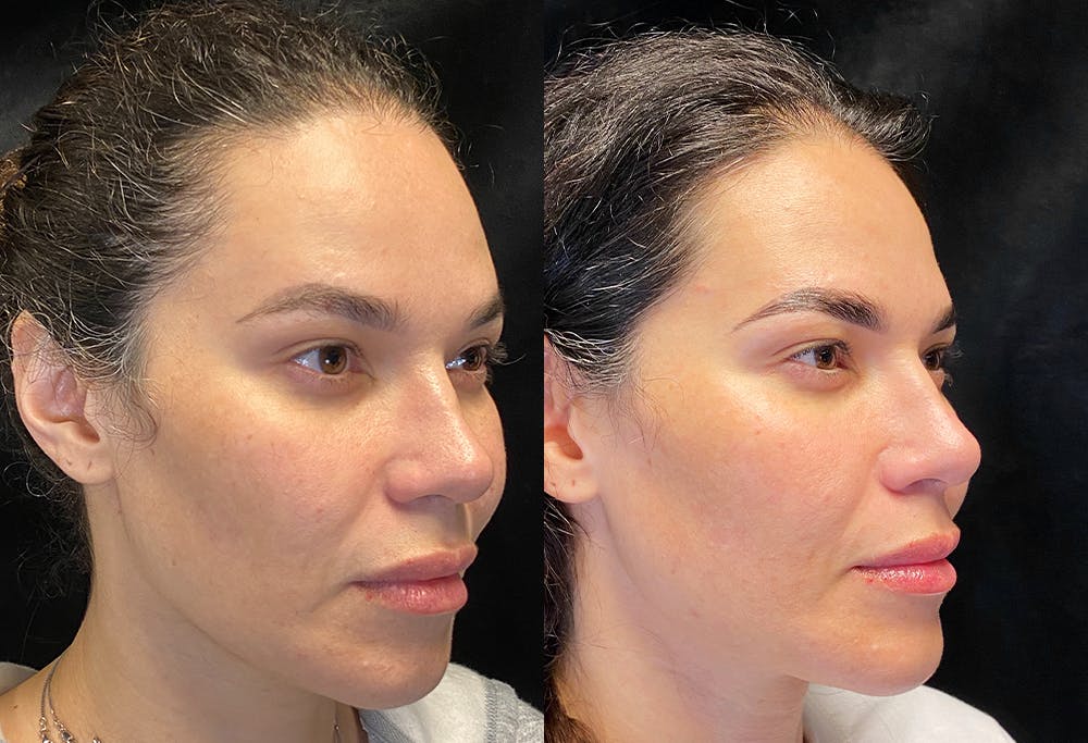 Sculptra Before & After Gallery - Patient 344311 - Image 2