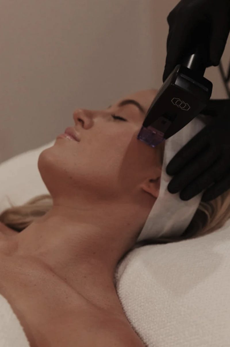 Patient Receiving Morpheus8