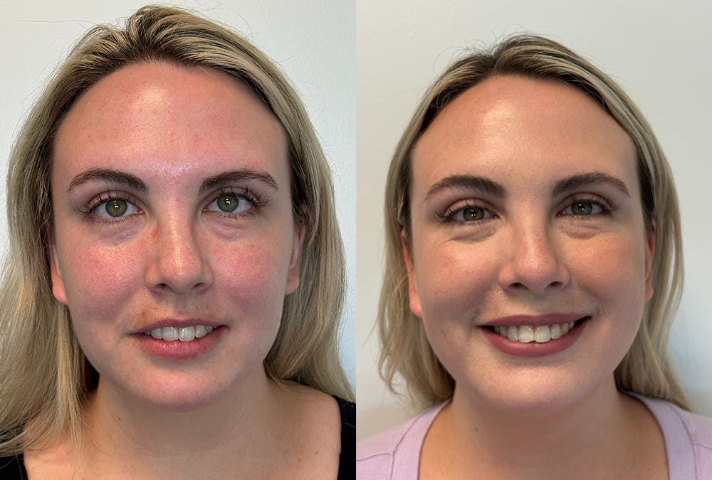 BOTOX/Dysport Before & After Gallery - Patient 402377 - Image 2