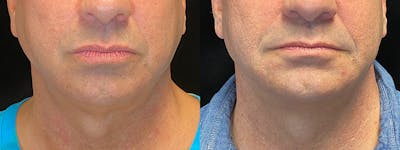 Sculptra Before & After Gallery - Patient 737860 - Image 1