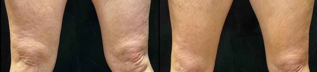 EvolveX Before & After Gallery - Patient 353818 - Image 1