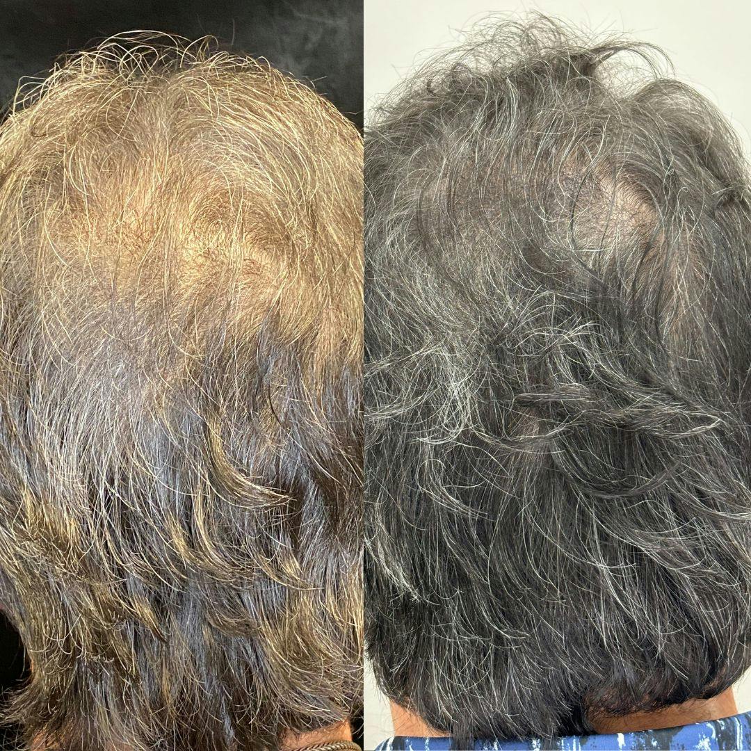 PRP Hair Restoration Before & After Gallery - Patient 411482 - Image 1