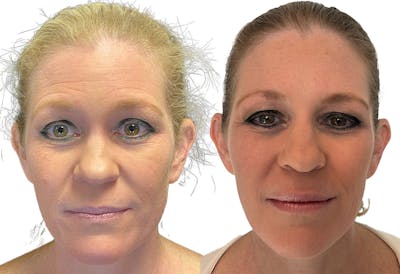 Dermal Fillers Before & After Gallery - Patient 141294 - Image 1