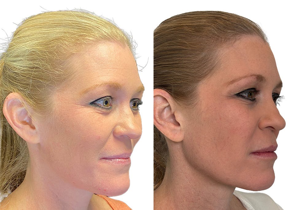 Dermal Fillers Before & After Gallery - Patient 141294 - Image 2