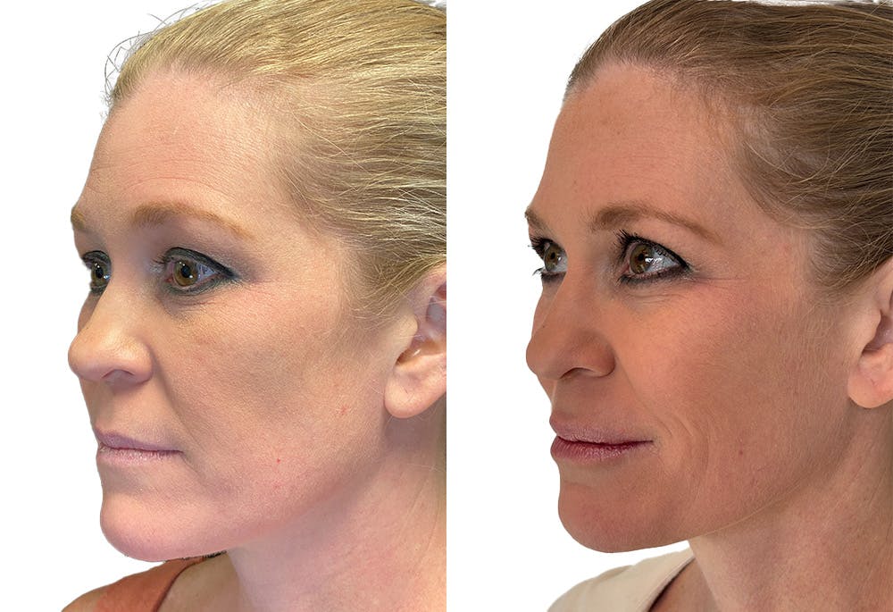 Dermal Fillers Before & After Gallery - Patient 141294 - Image 3